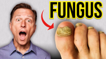 Thumbnail for How to Get Rid of Toenail Fungus Fast! | Dr. Eric Berg DC