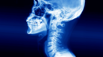 Thumbnail for A Man Swallowed A Wireless Ear Bud. This Is What Happened To His Stomach. | Chubbyemu