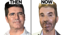 Thumbnail for Simon Cowell NEW FACE | Plastic Surgery Analysis