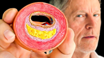 Thumbnail for #1 Best Way to Find CLOGGED Arteries | Dr. Ford Brewer