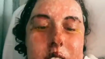 Thumbnail for Horrific Side Effects From the Covid Jab It’s making this woman melt.