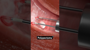 Thumbnail for Removing a polyp from your uterus (3D Animation) | Viz Medical