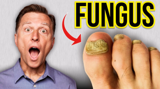 Thumbnail for How to Get Rid of Toenail Fungus Fast! | Dr. Eric Berg DC