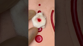 Thumbnail for Gunshot Wound First Aid ⛑️ #emergency #goodtoknow #firstaid #vet #medicine #funfacts #surgeonlife | Vetventures