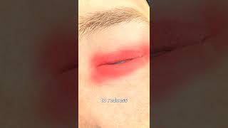 Thumbnail for What Is Pink Eye? 😳 | Zack D. Films